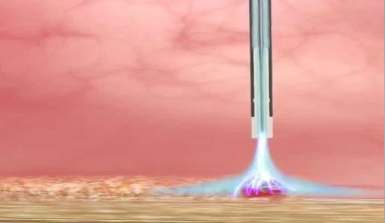 Argon Plasma Coagulation