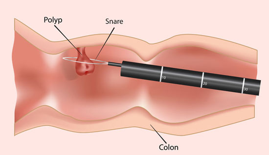 Polypectomy