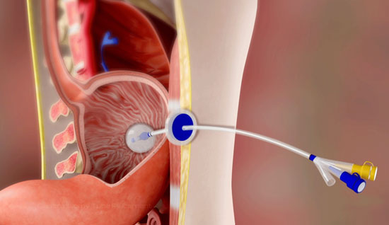 PEG Tube Insertion