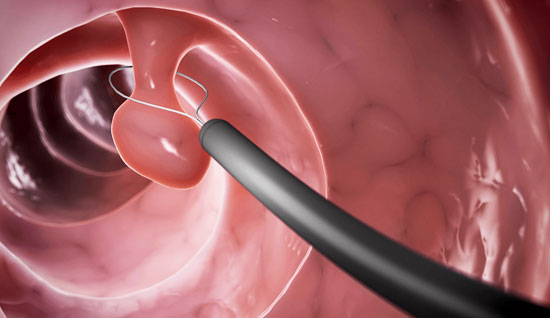Sigmoidoscopy
