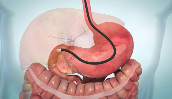 ERCP
