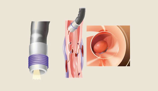 Band Ligation